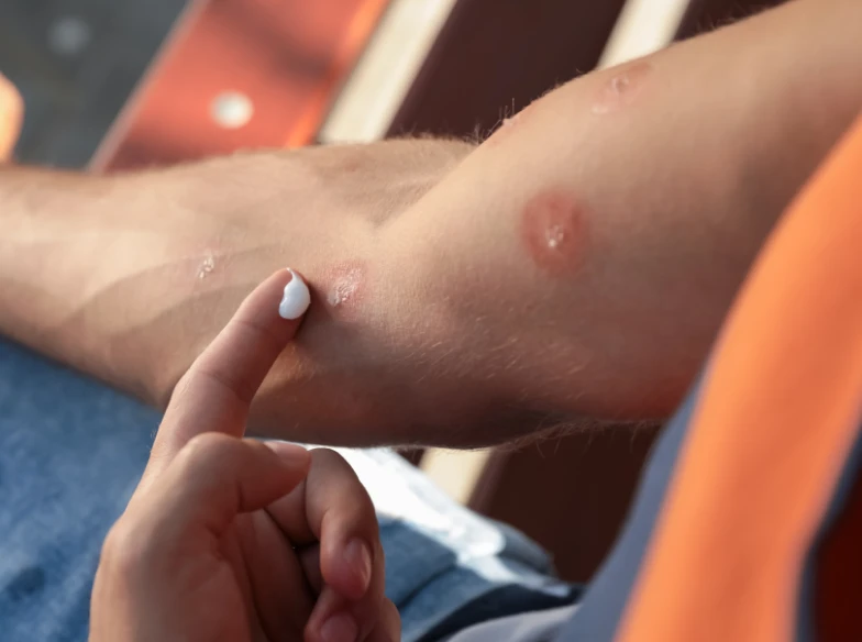 A close up of an arm with a rash.